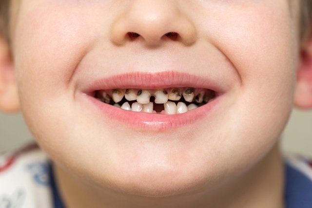 Rotten tooth: 4 main causes (and how to treat)