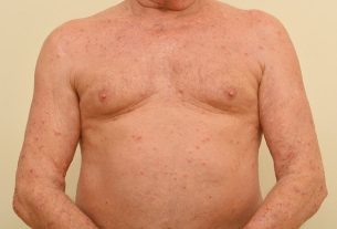 Scabies: what it is, symptoms, how it is caught and treatment