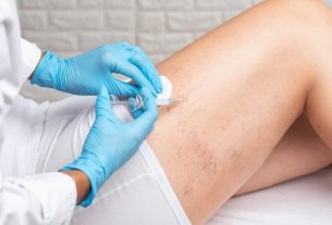 Sclerotherapy: what it is, when it is indicated, types and how it is done