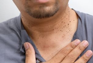 Seborrheic keratosis: what it is, symptoms, causes and treatment