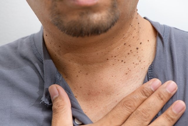 Seborrheic keratosis: what it is, symptoms, causes and treatment