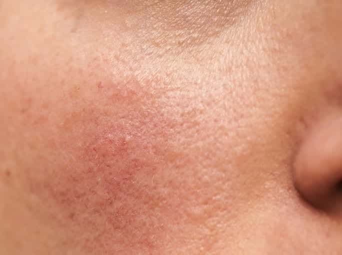 Sensitive skin, what it is, what are the symptoms and treatments