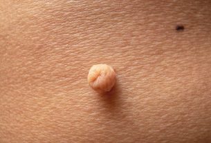 Soft fibroma (acrochordon): what it is, causes and treatment