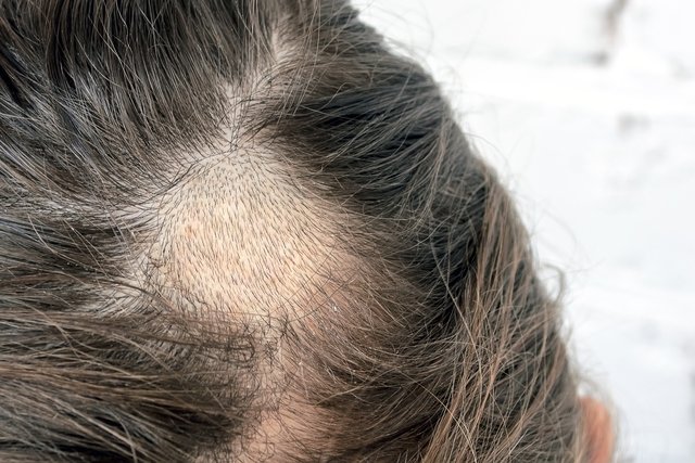 Tinea capitis (tinea capitis): what it is, symptoms, causes and treatment