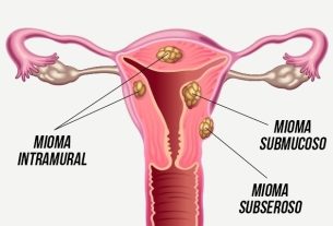 Types of uterine fibroids: main symptoms and how to treat