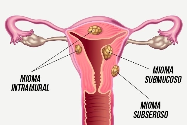 Types of uterine fibroids: main symptoms and how to treat