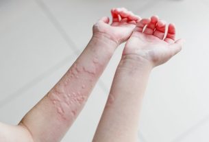 Urticaria: what it is, symptoms, causes, types and treatment