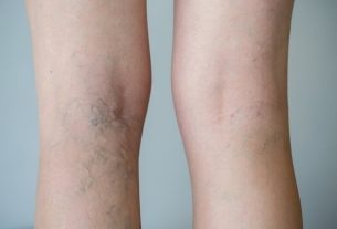 Varicose vein doctor: which specialist to consult?