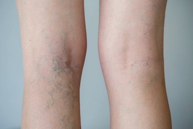 Varicose vein doctor: which specialist to consult?