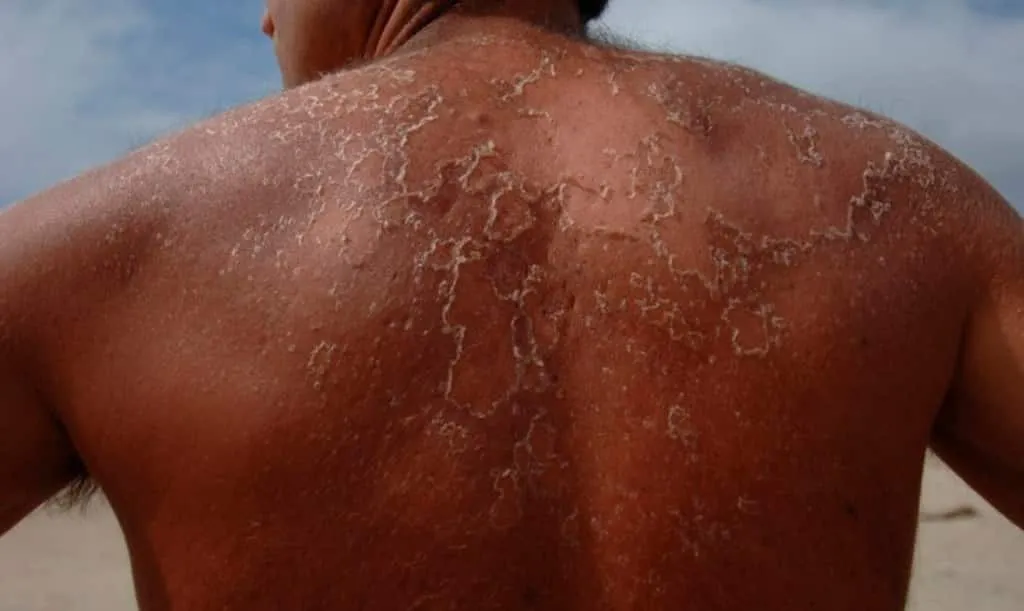 Peeling skin - why does it happen, treatments and daily care