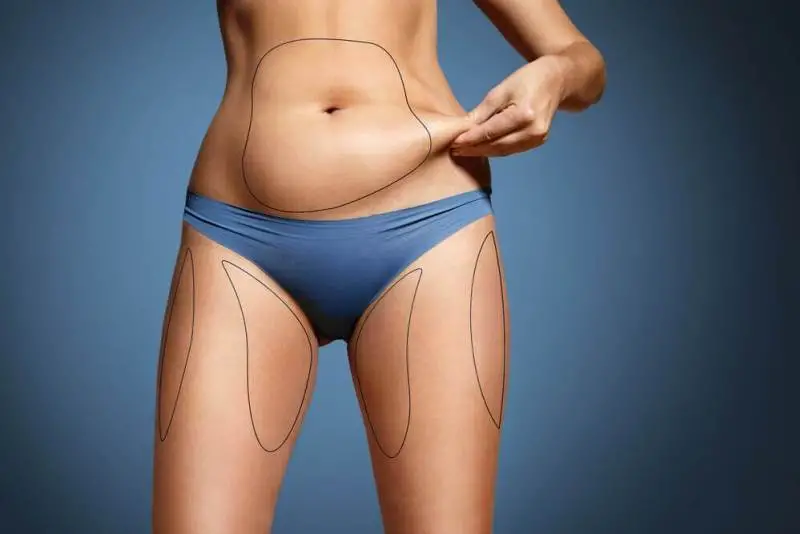 Liposuction - how it is done, risks, post-operative period and prices