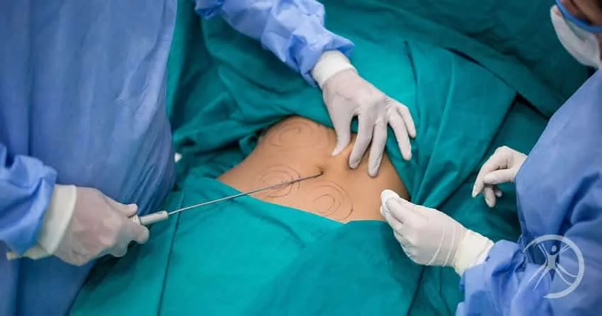 Liposuction - how it is done, risks, post-operative period and prices