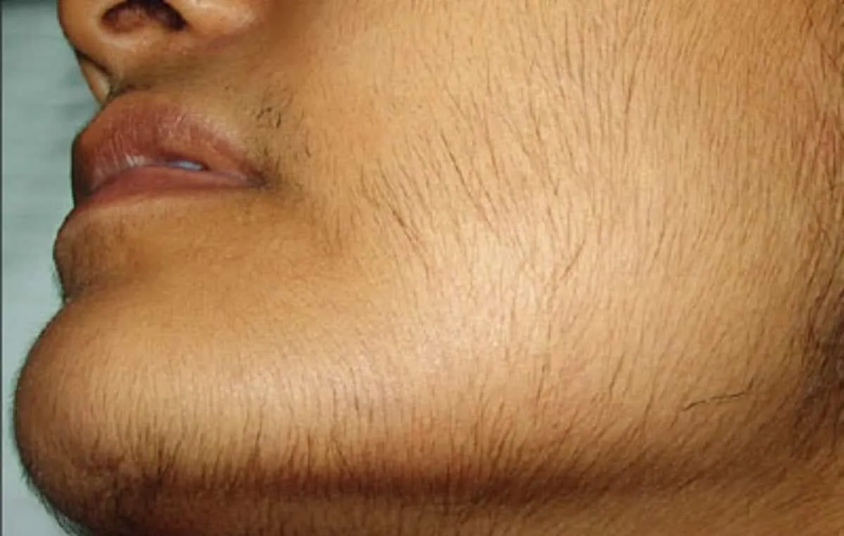 Hirsutism, what is it, what are the symptoms, how is it treated?