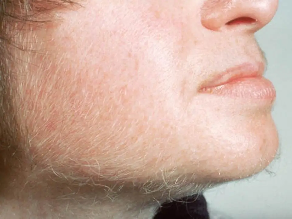 Hirsutism, what is it, what are the symptoms, how is it treated?