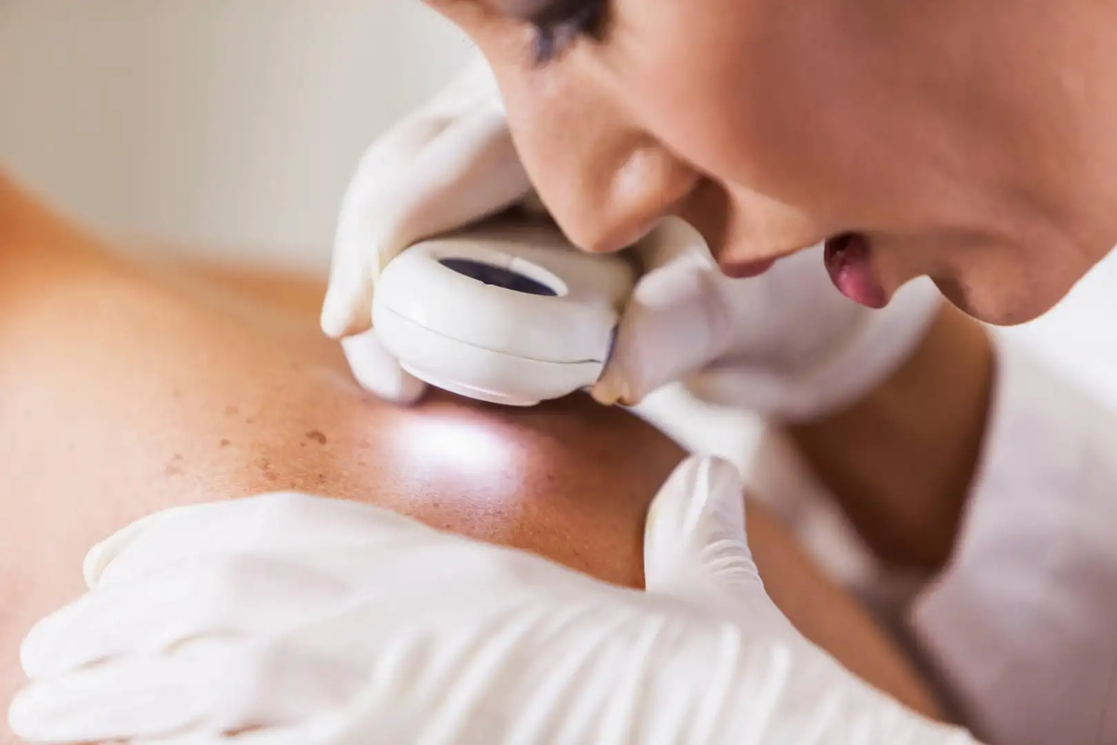 Ingrown hair - What it is, causes, how to treat and prevent