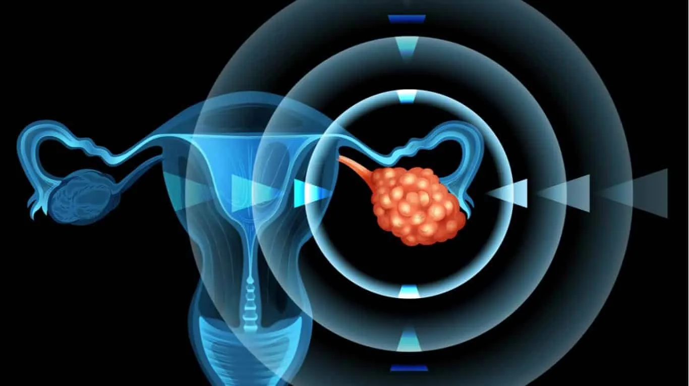 Polycystic ovary – What it is, causes, symptoms, treatments and curiosities