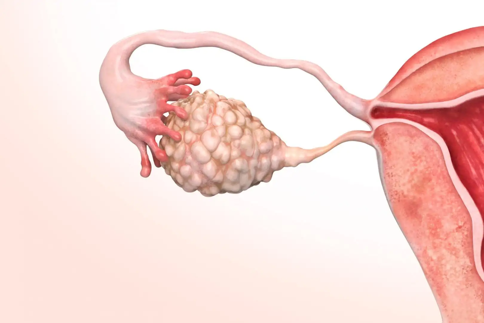 Polycystic ovary – What it is, causes, symptoms, treatments and curiosities