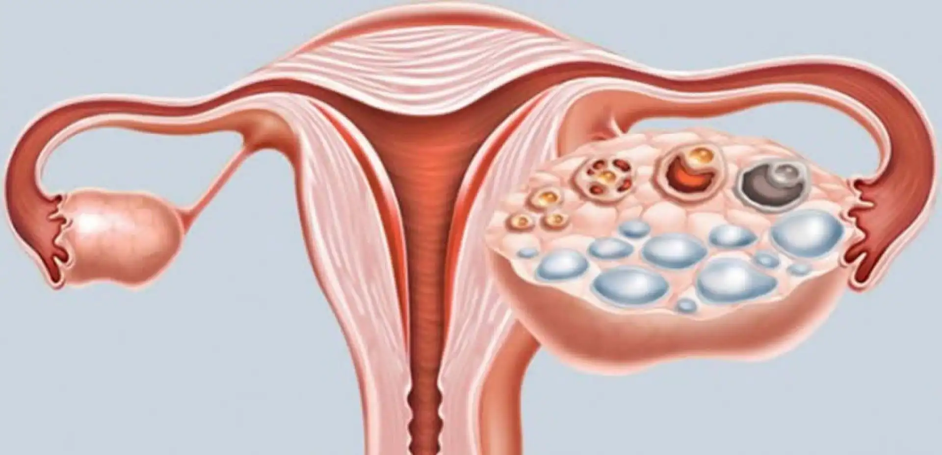 Polycystic ovary – What it is, causes, symptoms, treatments and curiosities