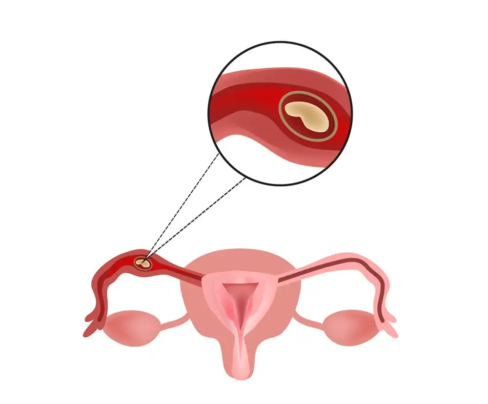 Ectopic Pregnancy - what it is, risk factors, symptoms and how to deal with it