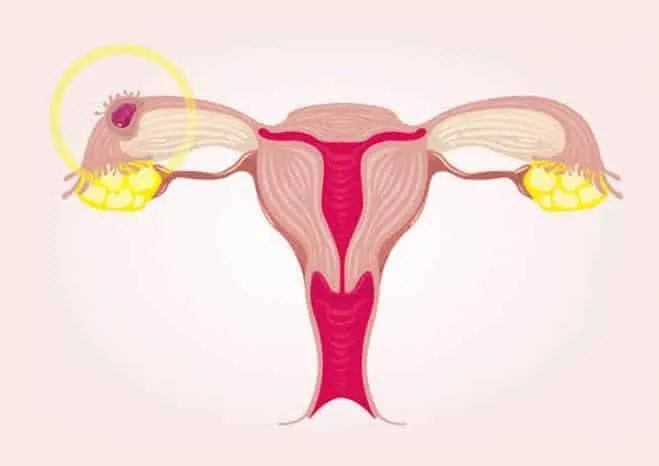 Ectopic Pregnancy - what it is, risk factors, symptoms and how to deal with it