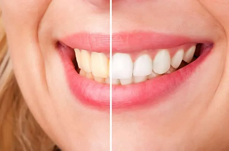 White teeth - main office and home treatments