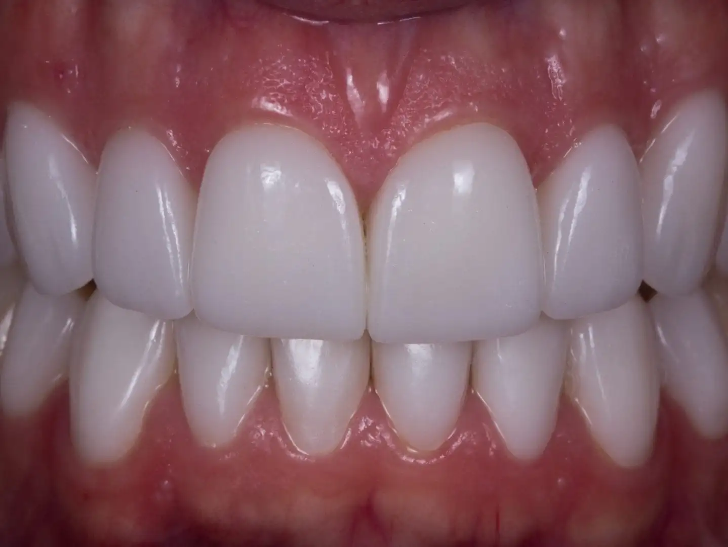 White teeth - main office and home treatments