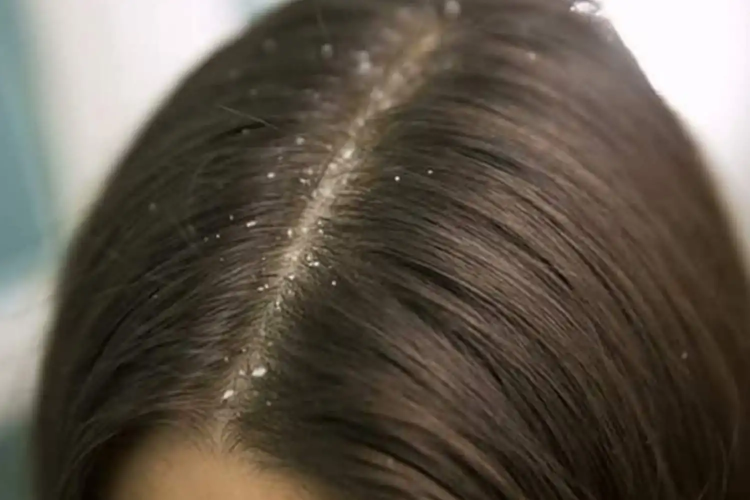 Anti-dandruff shampoo - how often to use and 4 best products