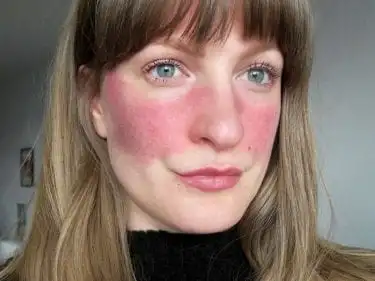 Rosacea – What it is, symptoms, causes, and treatment