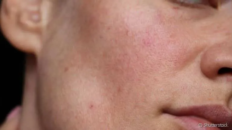 Rosacea – What it is, symptoms, causes, and treatment