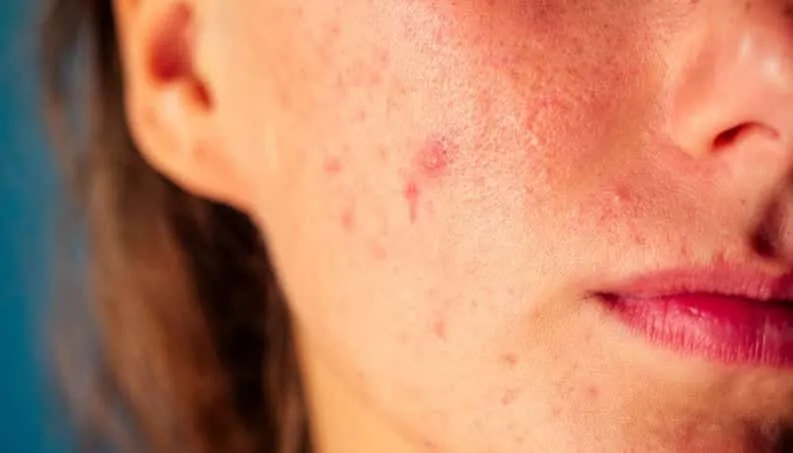 Skin problems - diseases that cause blemishes on the skin