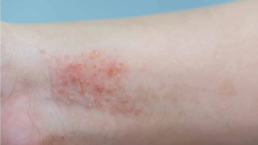 Skin problems - diseases that cause blemishes on the skin