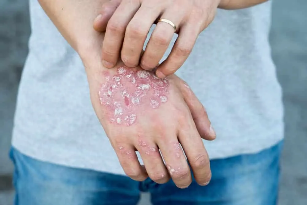 Skin problems - diseases that cause blemishes on the skin