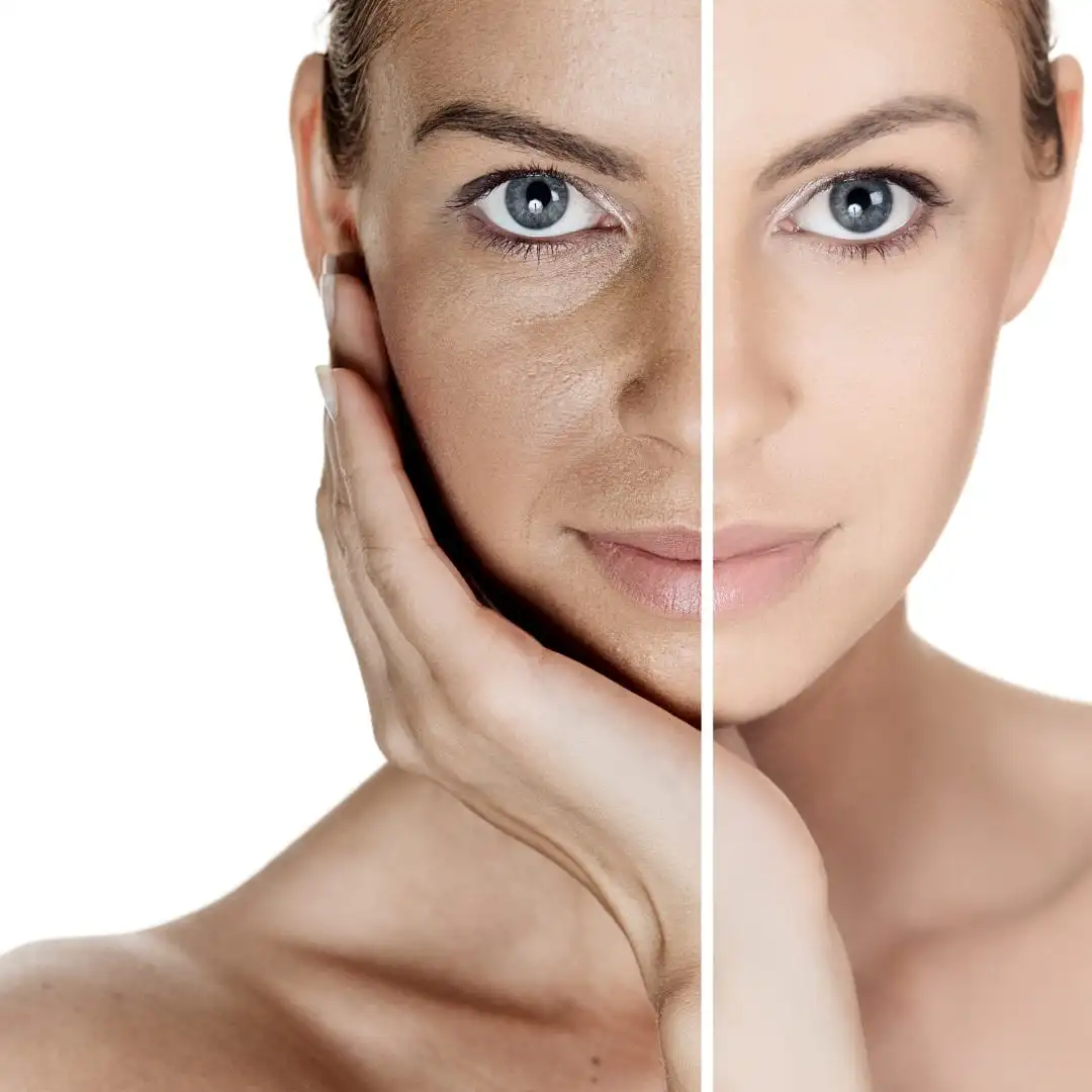 Glycolic acid - what it is, how to use it and indications