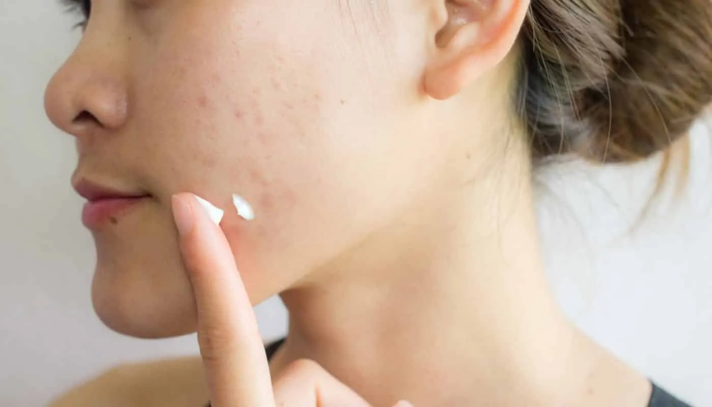 How to dry pimples - 8 effective home treatments to get rid of them