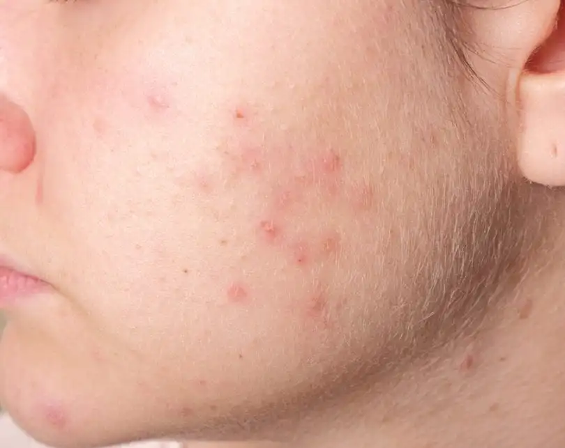 Find out what could be causing you the infamous pimples