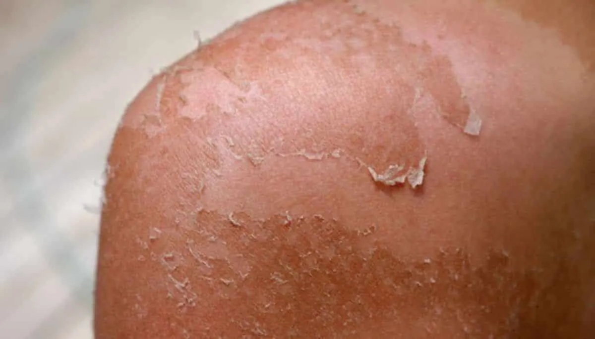 Peeling skin - why does it happen, treatments and daily care