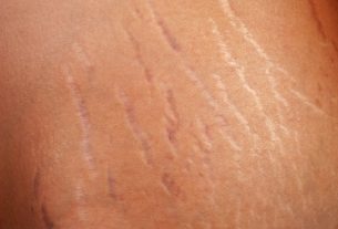 4 Tips to eliminate stretch marks