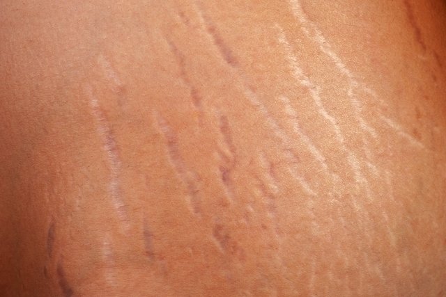 4 Tips to eliminate stretch marks