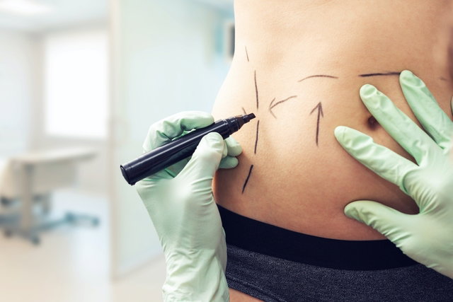 Belly plastic surgery: main types and recovery