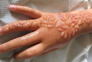 Henna tattoo causes permanent scars on 7-year-old girl