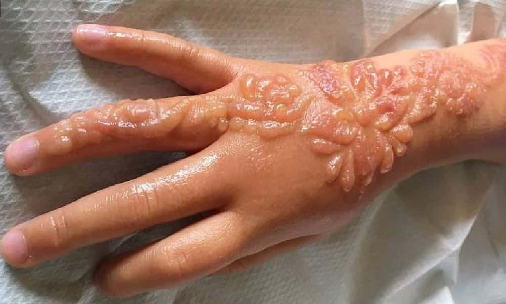 Henna tattoo causes permanent scars on 7-year-old girl