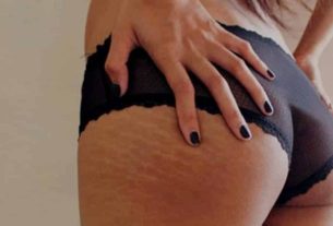 7 truths about stretch marks that dermatologists don't tell you