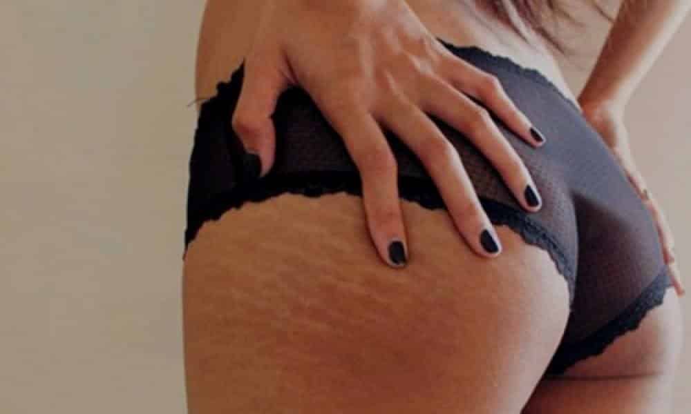 7 truths about stretch marks that dermatologists don't tell you