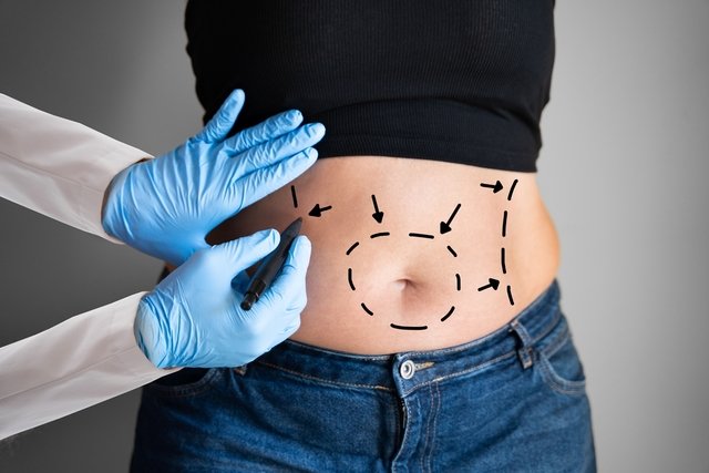 Main risks of abdominoplasty and how to avoid them