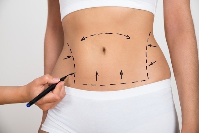 Abdominoplastia com lipo: como é feita, resultados e pós-operatório