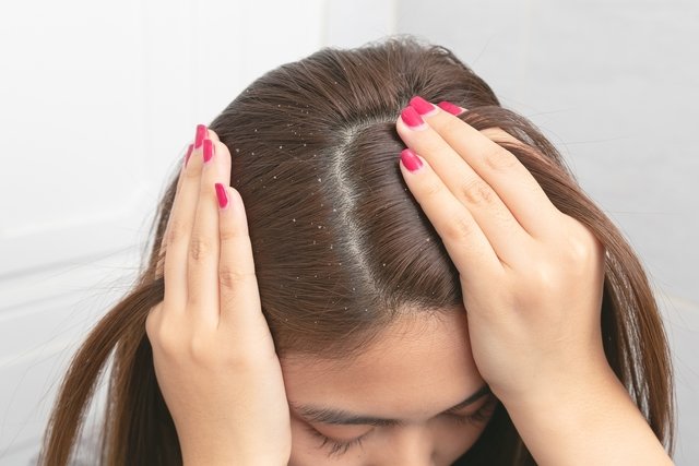 How to get rid of dandruff: shampoos, remedies and simple tips