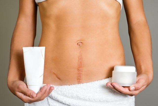 5 Treatments to remove old scars