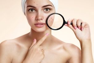 Acne - what to eat and what to avoid to combat pimples