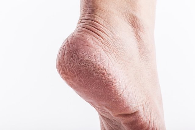 How to keep diabetic feet healthy