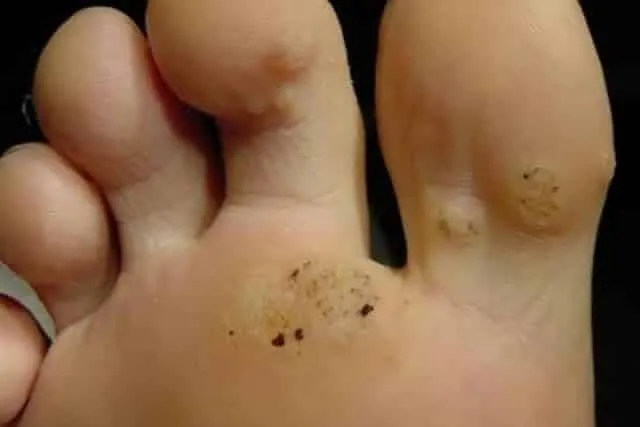 Calluses on your feet, how can you get rid of them with an aspirin-based home remedy?